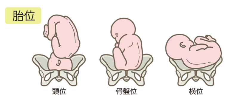 胎位異常とは？逆子や横位の原因・治る確率と分娩方法を解説 | 千葉西総合病院 産婦人科｜松戸市、柏市